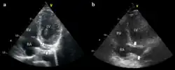 It is possible to place the lead in the coronary sinus, normal (left) dilated (right). Such placement is okay.