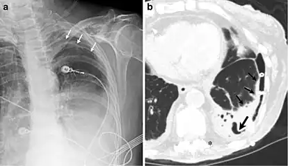 Chest X-ray (left) and CT scan (right) demonstrating fibrothorax