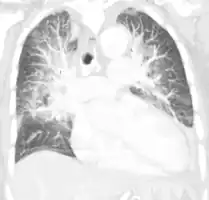 Pulmonary edema on CT-scan (coronal MPR)