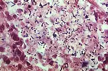 Photomicrograph reveals the presence of numerous Gram-positive, Listeria monocytogenes bacteria, harvested from the lung of a newborn with listeriosis.