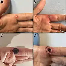 Progression of monkeypox after needlestick injury from a pustule at work