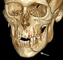 3D CT reconstruction of mandible fracture, white arrow marks fracture, red arrow marks moderate displacement and open bite