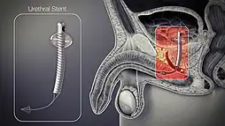 3D Medical Animation still shot of Urethral Stent