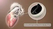 3D Medical Animation still shot of Artificial Heart Valve