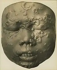 Secondary breakout in a Javanese child age of 12 years. Wax model