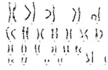 Karyotype of 47,XXY. The only difference for 48,XXXY would be a third X chromosome.