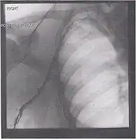 After treatment with catheter-directed thrombolysis, blood flow in the axillary and subclavian vein were significantly improved. Afterwards, a first rib resection provided thoracic outlet decompression to reduce the risk of recurrent DVT and the risk of sequelae from thoracic outlet compression.
