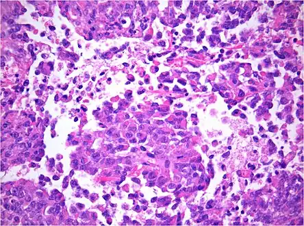 AT/RT Histology with numerous rhabdoid tumor cells