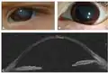 A case of keratoglobus in a case of Brittle cornea syndrome