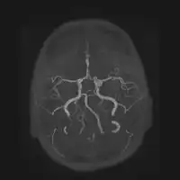 Accessory middle cerebral artery and ICA aneurysm