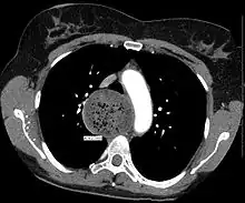 An axial CT image showing marked dilatation of the esophagus in a person with achalasia.