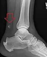 Achilles tendon avulsion seen on plain X-ray