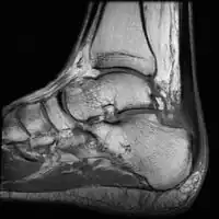 Achilles tendinopathy and peritendonitis