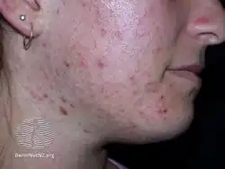 Acne on face