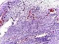 Micrograph of appendicitis showing neutrophils in the muscularis propria. H&E stain.