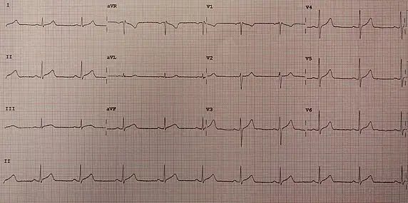ECG showing slight ST elevation in many leads congruent with pericarditis