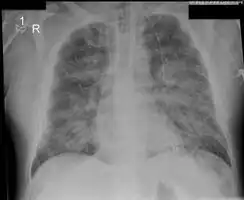 Acute pulmonary edema
