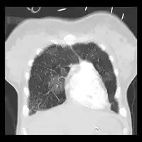 Acute pulmonary edema on CT
