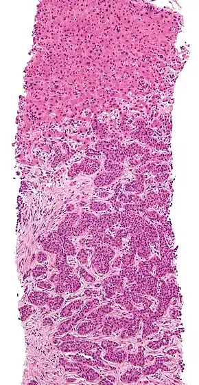 Metastasis proven by liver biopsy (tumor (adenocarcinoma)—lower two-thirds of image). H&E stain.