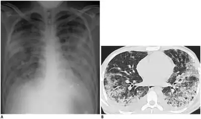 Adenovirus pneumonia chest X-ray and CT-scan