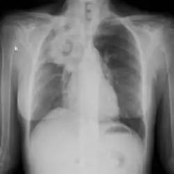 Large cavity mass lesion seen right upper lung