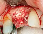 If bone width is inadequate it can be regrown using either artificial or cadaveric bone pieces to act as a scaffold for natural bone to grow around.