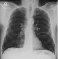 Alpha-1-antitrypsin deficiency/frontal radiograph lungs