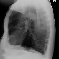 Alpha-1-antitrypsin deficiency/lateral radiograph lungs