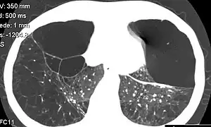 Computed tomography of the lung showing emphysema and bullae in the lower  lobes of a subject with type ZZ alpha-1 antitrypsin deficiency. There is also increased lung density in areas with compression of lung tissue by the bullae.