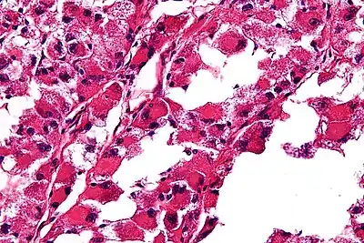High-magnification micrograph showing the characteristic large cells with abundant eosinophilic, i.e. pink, cytoplasm and an eccentrically placed nucleus