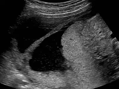 Amniotic sheet on ultrasound