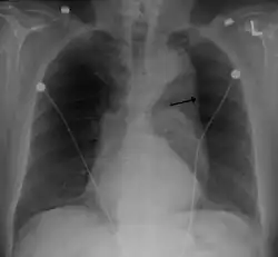 Thoracic aortic aneurysm with arrow marking the lateral border of the aorta