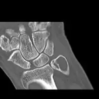 CT scan: ABC ulna near wrist