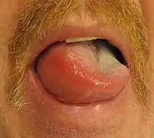 Angioedema of half of the tongue