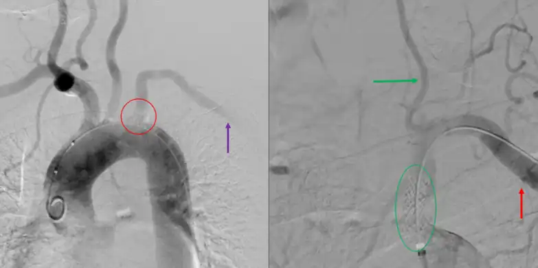 Angiogram of subclavian steal phenomenon before and after stent placement