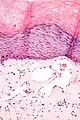 Scrotal angiokeratoma; visible large dilated blood vessels and hyperkeratosis