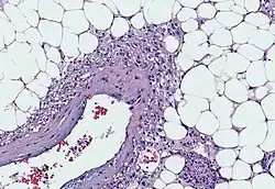 Myoid cells with clear cytoplasm spinning off of large vessels in a background of mature fat, the classic microscopic features of angiomyolipoma