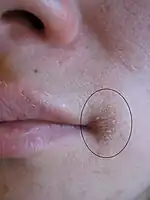 A fairly mild case of angular cheilitis extending onto the facial skin in a young person (affected area is within the black oval)