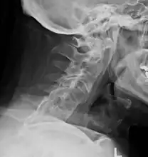 Lateral X-ray of the neck in ankylosing spondylitisImaging
