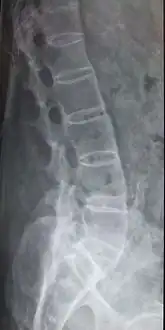 Lumbar spine showing advanced ankylosing spondylitis which can lead to spinal stenosis