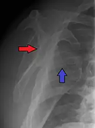 Anterior dislocation of the right shoulder. Y view X ray.