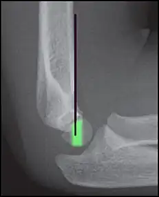 Anterior humeral line (black line), with normal area passed on the capitulum of the humerus  colored in green in a 4 year old child.