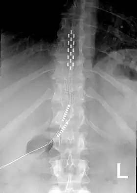 An x-ray showing a spinal cord stimulator implanted into the thoracic spine.