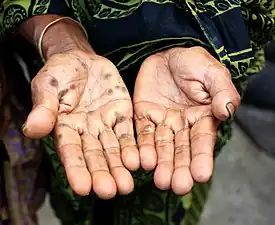Rash on the palms due to arsenic poisoning