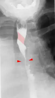 Tape-like impression of the esophagus caused by aberrant subclavian artery. Below (arrows) narrowing of the esophagus by a tumor that is causing the swallowing problems.
