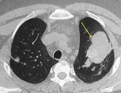 CT of the chest showing high attenuation mucous (HAM) impaction (yellow arrow). This is considered pathognomic for allergic bron­chopulmonary aspergillosis (ABPA).