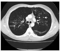 CT showing ‘signet ring’ (short, thick arrow) and ‘string of pearls’ (long, thin arrow) appearances, indicative of central bronchiectasis. Mucoid impaction and dilated bronchi are also seen.