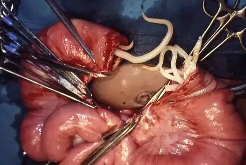 Example of ascariasis (ascaris infection) - Difficult surgical procedure in South Africa on a gangrenous piece of bowel that had to be cut out; live ascaris worms are emerging.