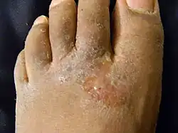 Athlete's foot (inflammatory with vesicles)