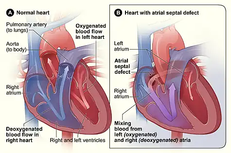 Atrial septal defect with left-to-right shunt